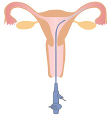 子宮ファイバースコープ下選択的卵管通水治療