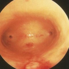 正常な子宮の内腔